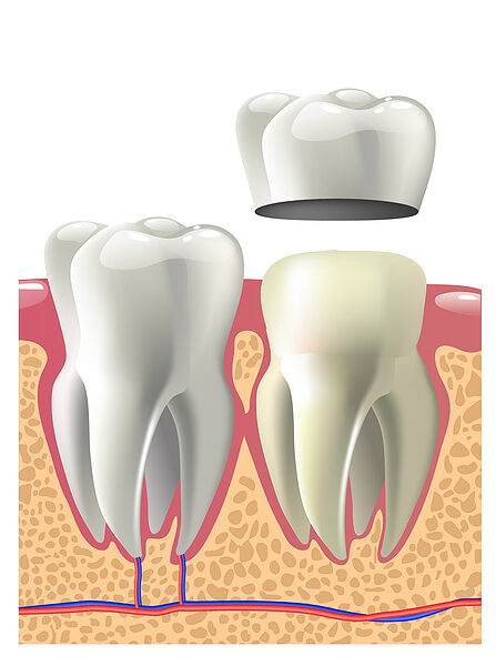 Ceramic-Crowns