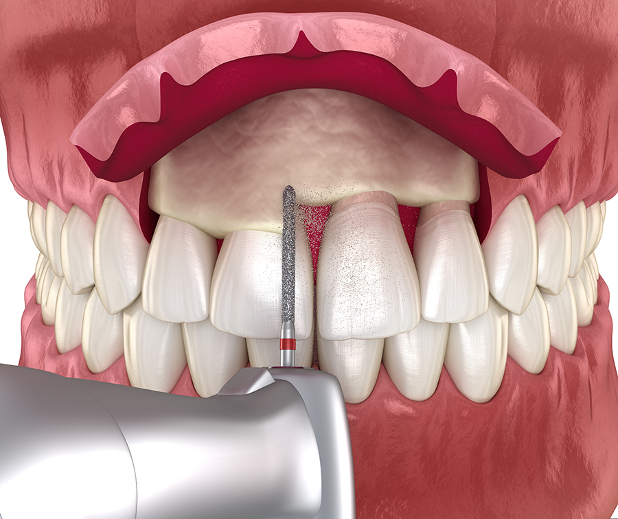 Crown-Lengthening