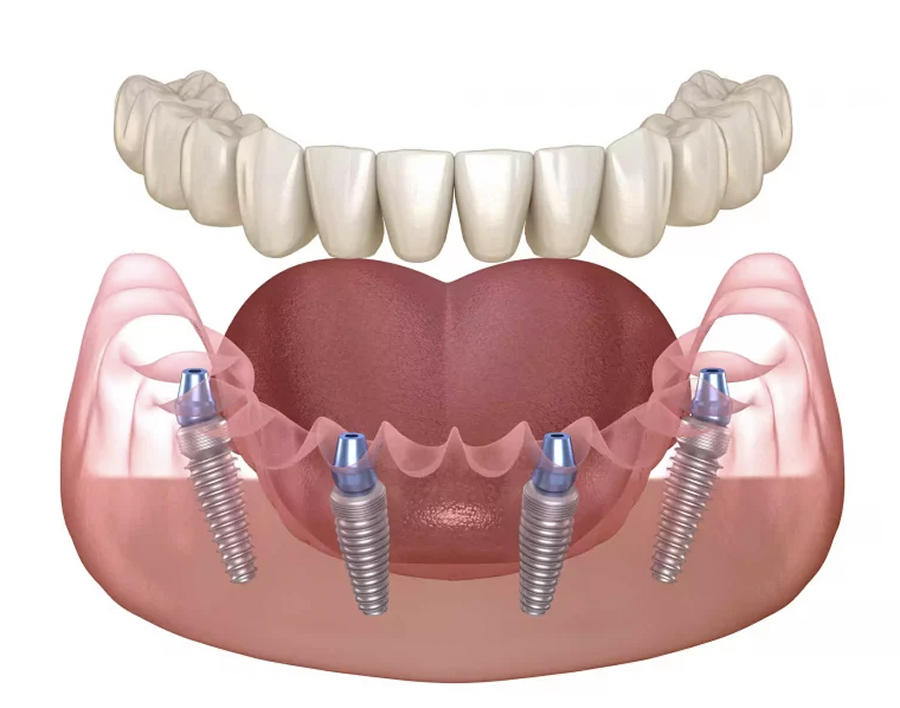 Dental-Implants-Dentist-Nassau-County