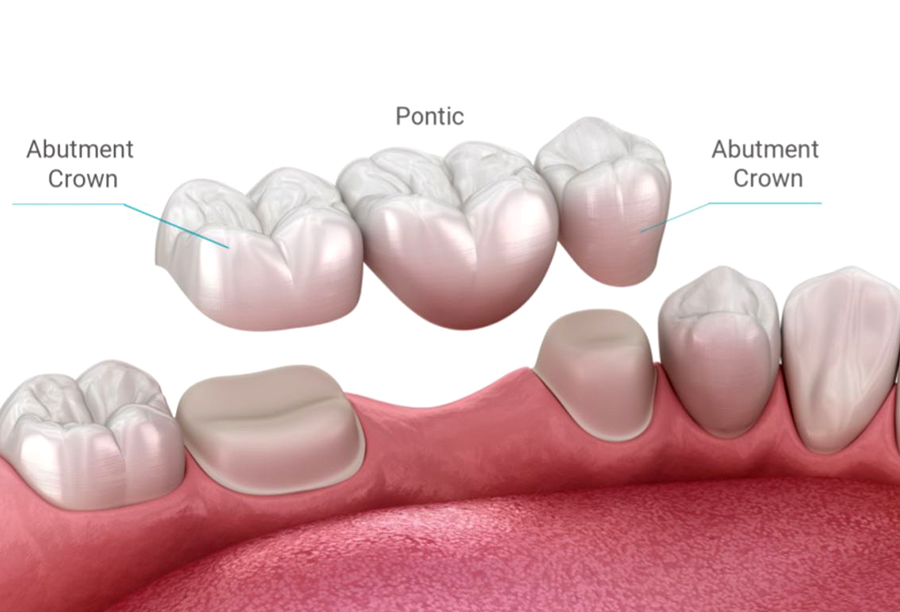 Fixed-Dental-Bridges-Treatment