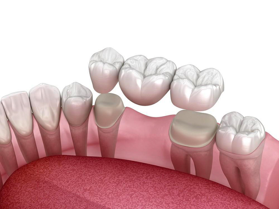 Fixed-Dental-Bridges