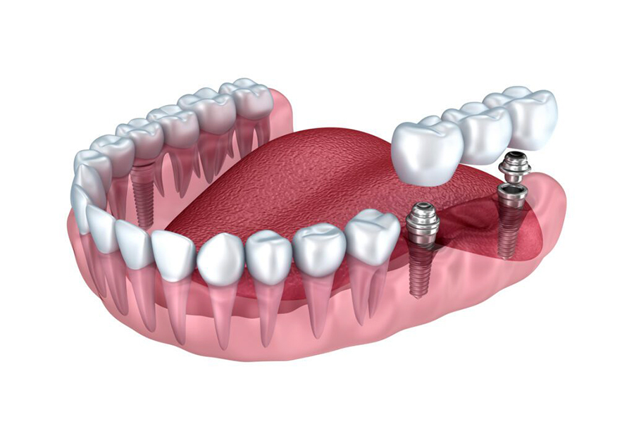 Implant-Dental-Bridges