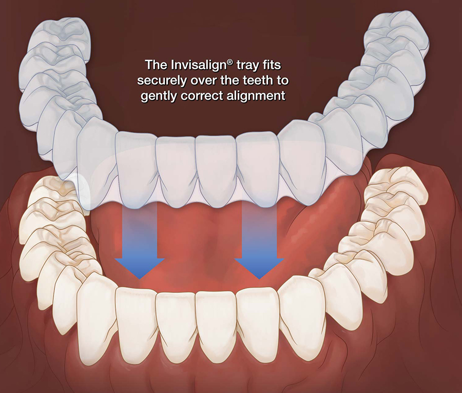 Kids Invisalign Dentist