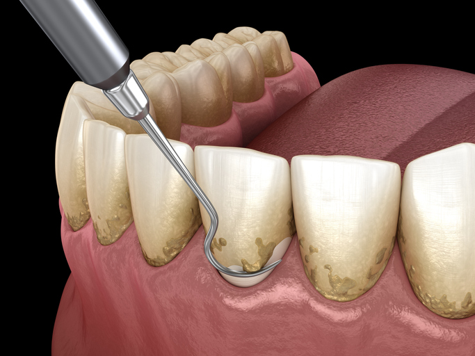 Periodontal-Therapy-Dentist