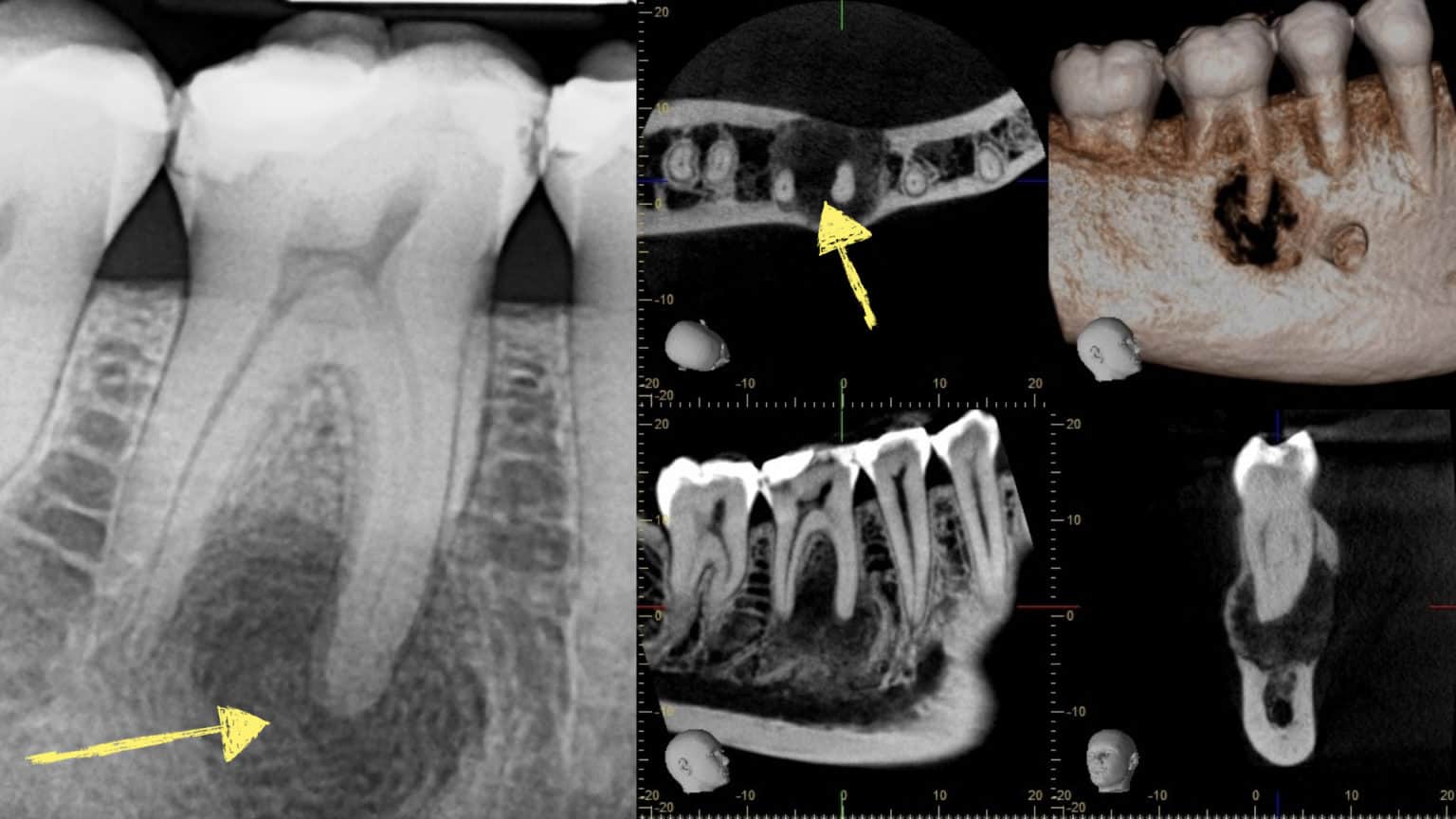 affordable root canal dentist