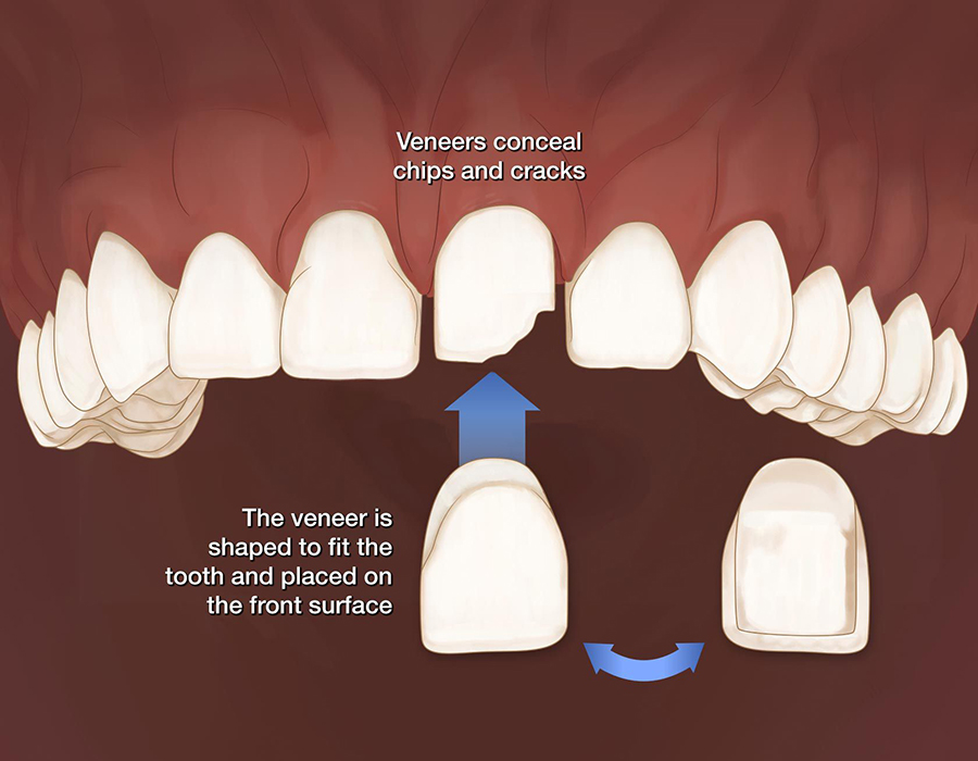 affordable-veneers-dentist