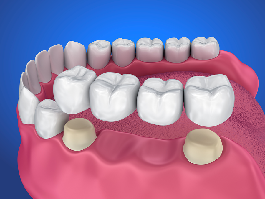 dental-bridge-dentist