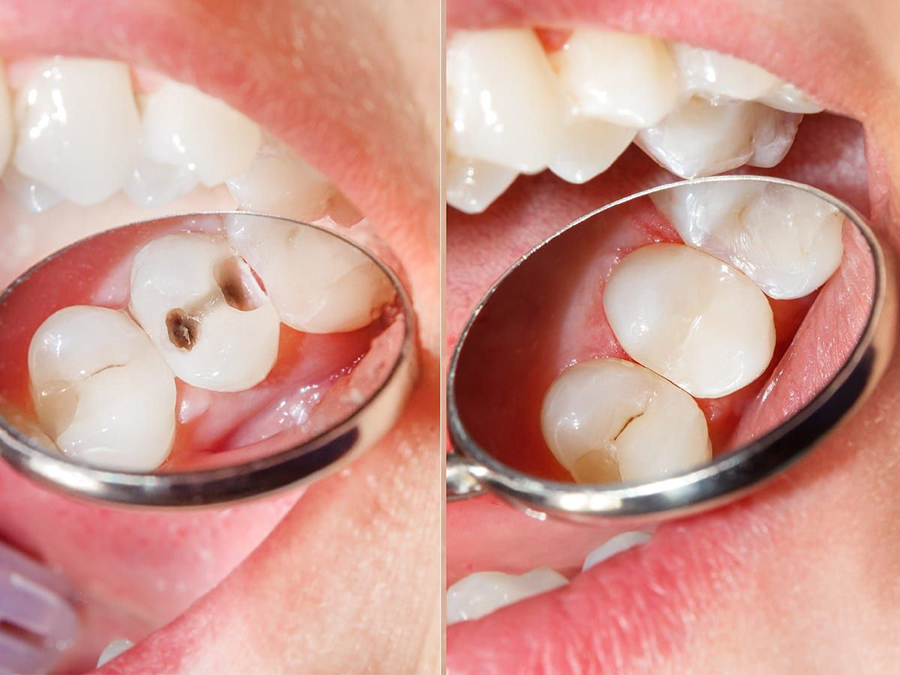 dental-fillings