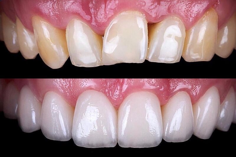 dental-veneers-dentist-before-after