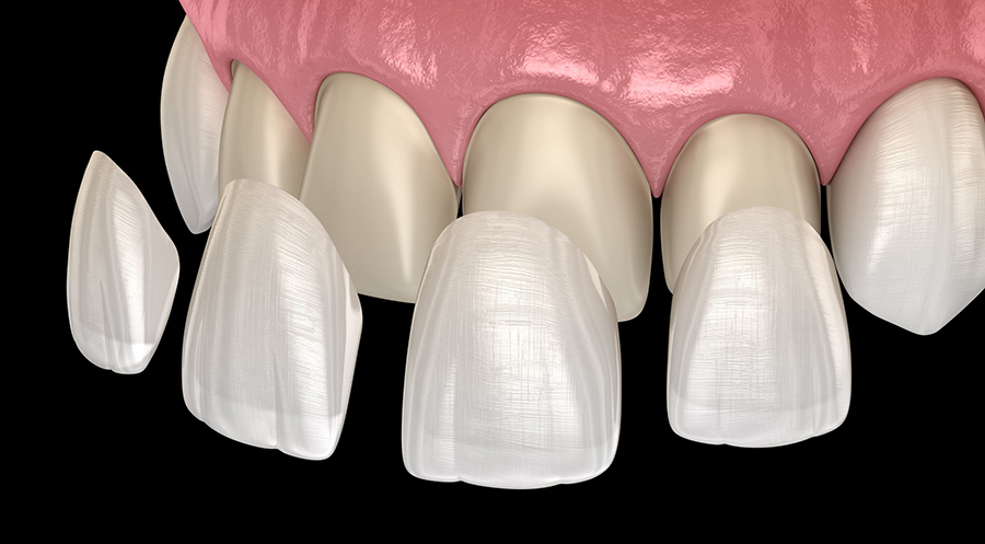 dental-veneers-dentist