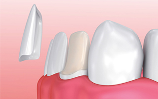 dental-veneers