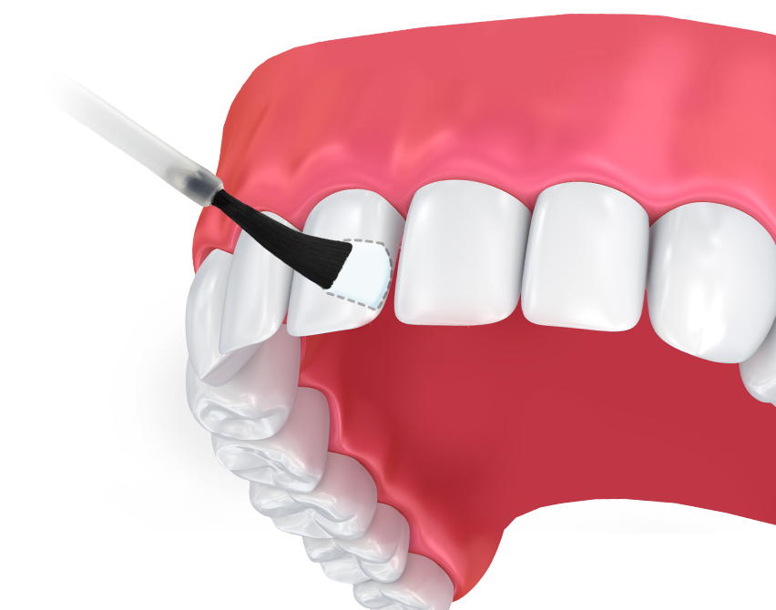 fluoride-treatments