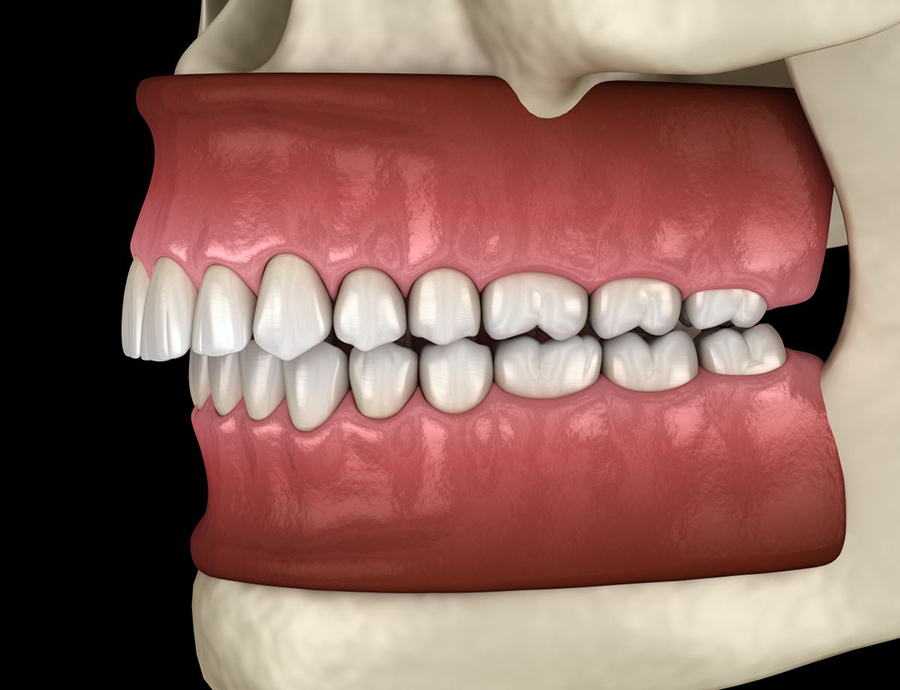 malocclusion-treatment