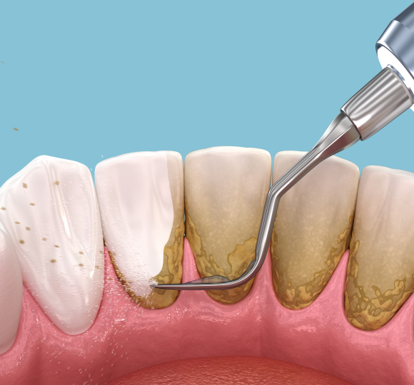 periodontal-therapy-dentist