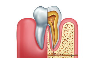 root-canal-dentist