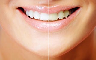 teeth-whitening-dentist