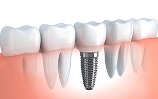 dental-implants-dentist