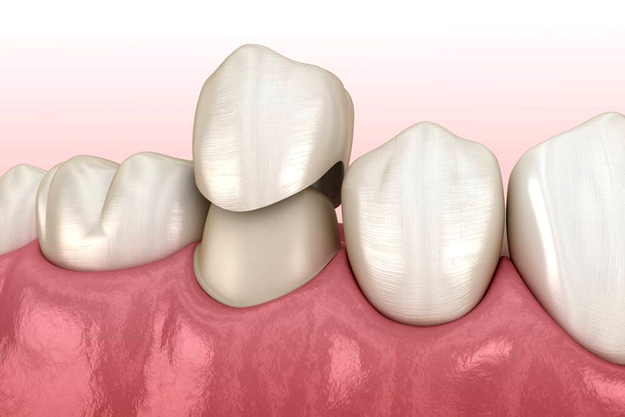 zirconia-crown-dentist