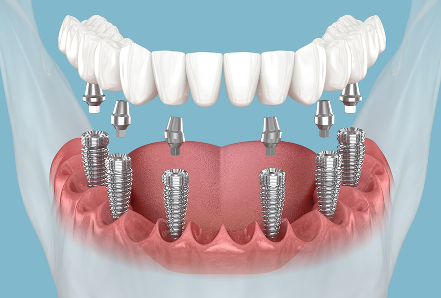 all-on-6-dental-implants