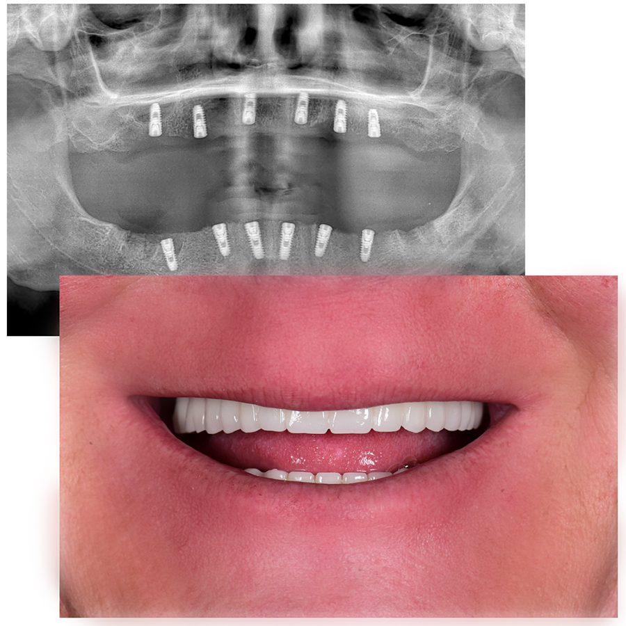 before-and-after-all-on-6-dental-implants