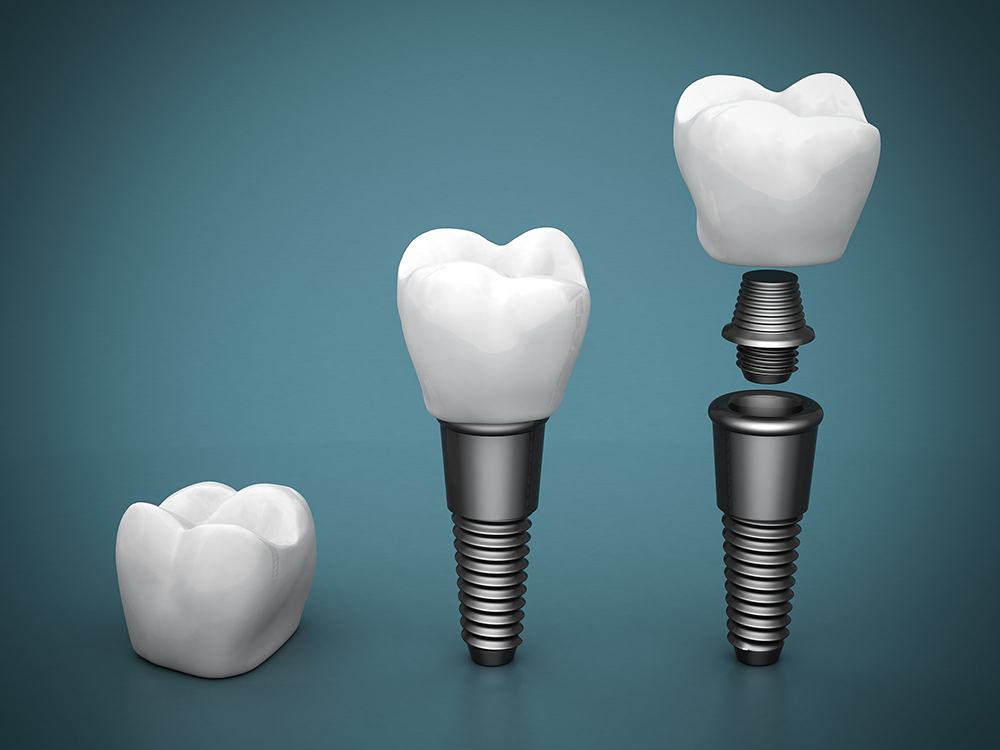 dental-implants-affordable-cost