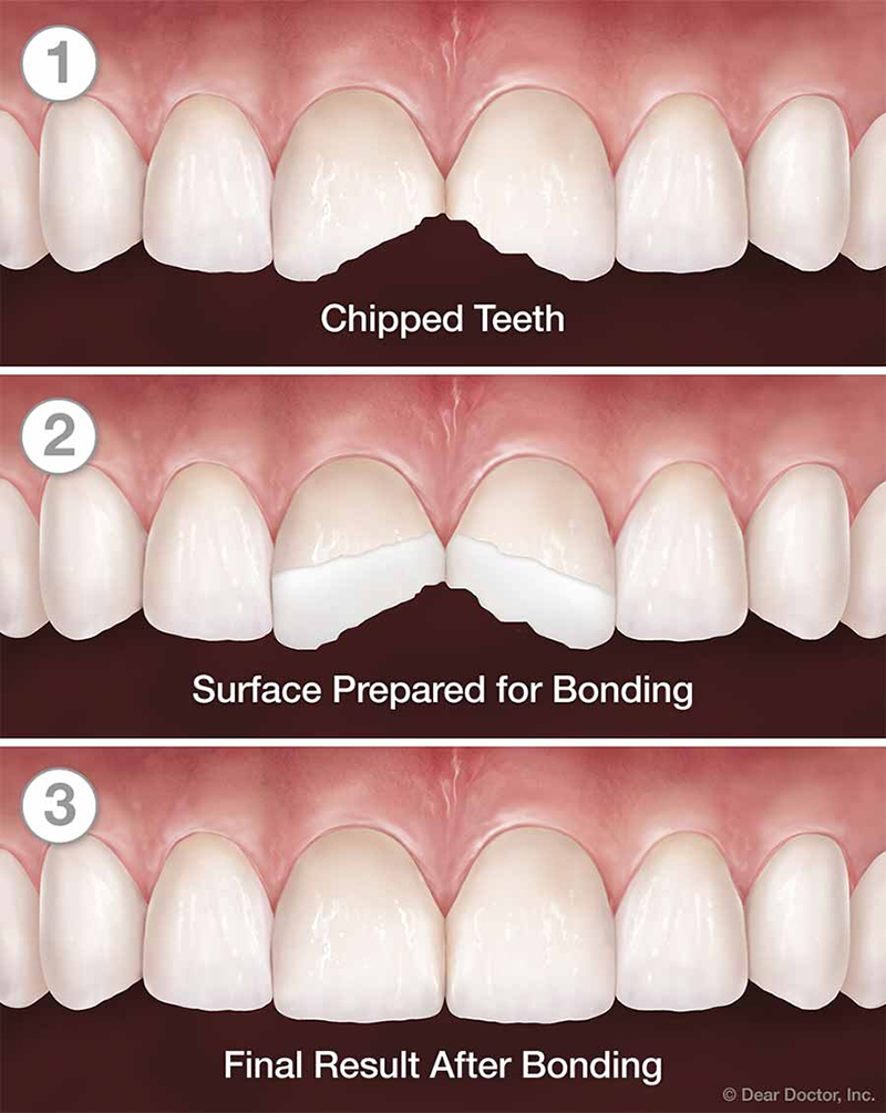 tooth-bonding-cosmetic-dentistry